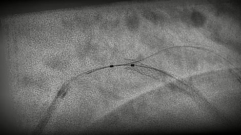 intervencionnaya-rentgenovskaya-sistema-philips-stentboost-live