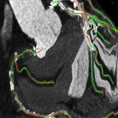 siemens-klinicheskoe-programmnoe-obespechenie-syngo-cto-guidance