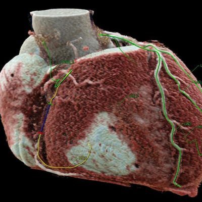 siemens-klinicheskoe-programmnoe-obespechenie-syngo-cto-guidance_2